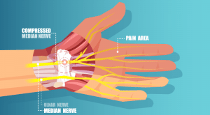 Carpal Tunnel Syndrome