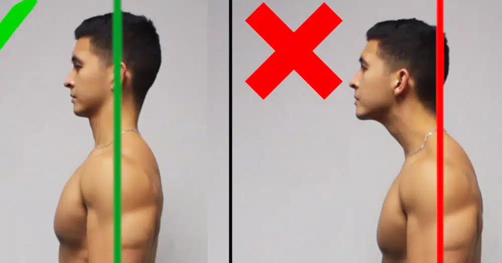 Forward head posture